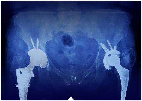 5 Tips Low Country Orthopedic